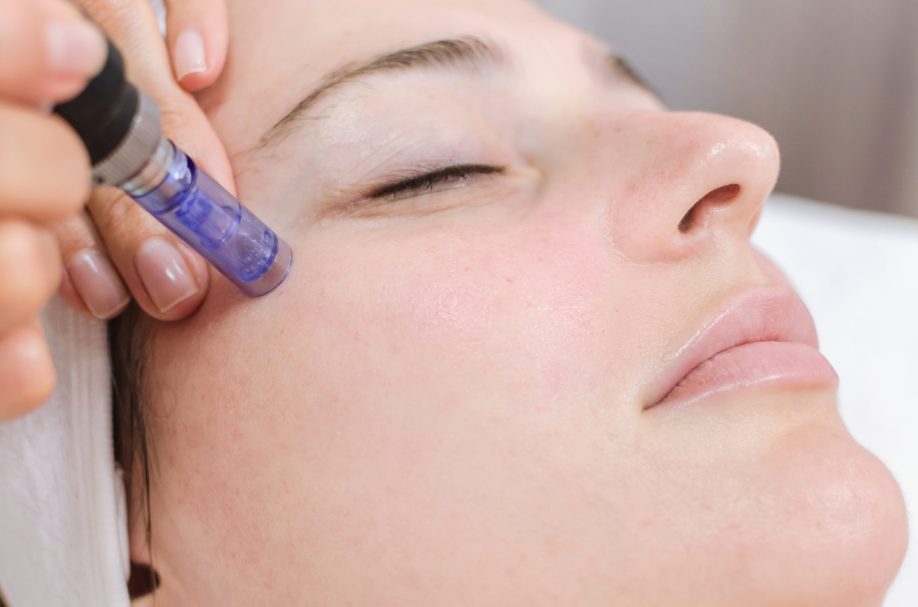 5 Reasons To Give Skin Micro-Needling A Try: